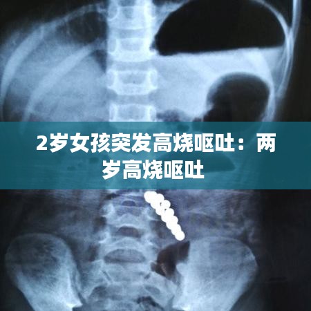 2岁女孩突发高烧呕吐：两岁高烧呕吐 