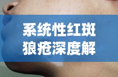 系统性红斑狼疮深度解析，症状、诊断与治疗