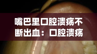 嘴巴里口腔溃疡不断出血：口腔溃疡嘴巴里有血 